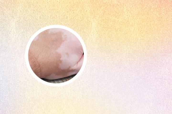 关于治疗白癜风的最新研究