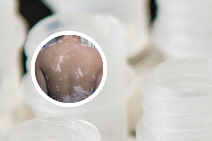 白癜风怎么运动最有效