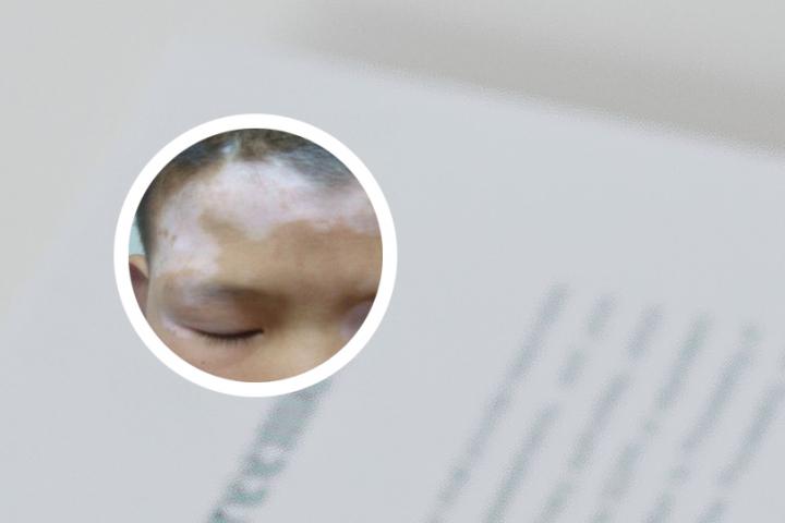 白癜风完全看不见吗