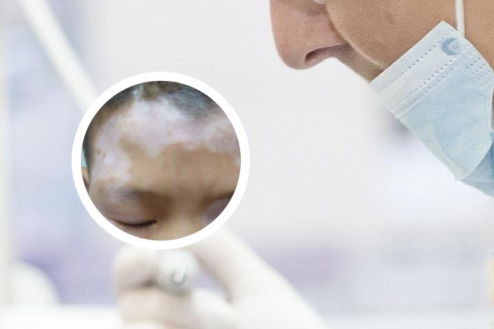白癜风晚期长啥样
