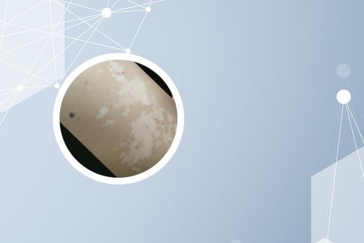 手术后长白癜风怎么治好