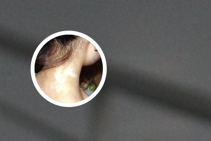 大妈肚皮上白癜风扩散视频