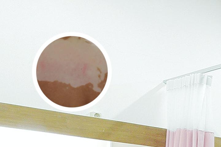 白癜风中医鉴别诊断