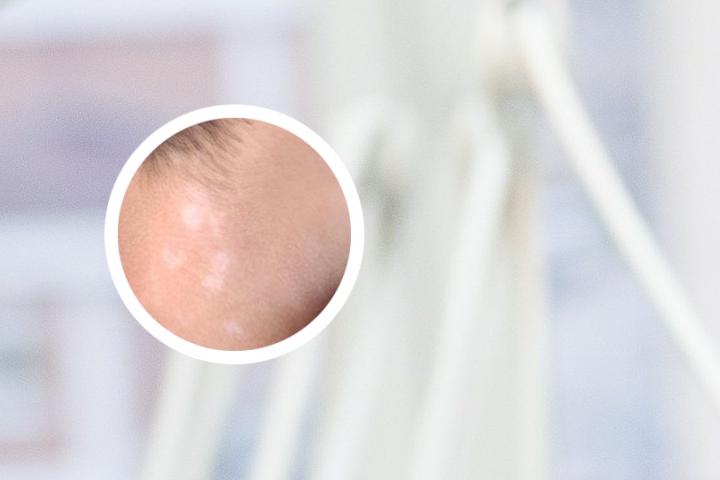小面积白癜风如何干预