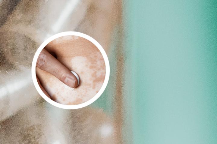白癜风病人能吃干话梅吗