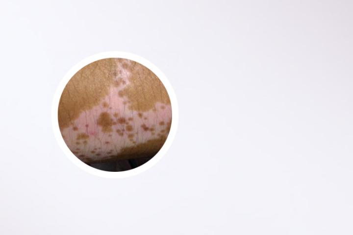 治白癜风的贵吗