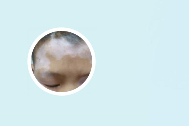 孕期白癜风的治疗方法