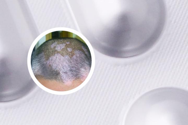 白癜风能吃蒺藜消白丸