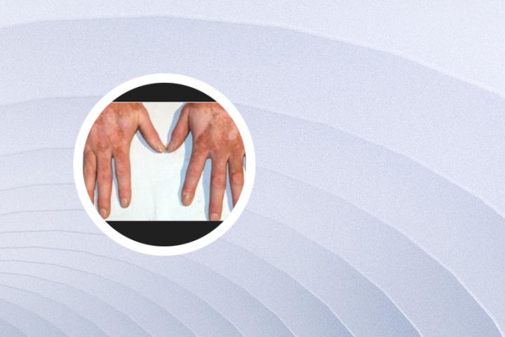 白癜风晚上可以加班吗 白癜风晚上可以加班吗