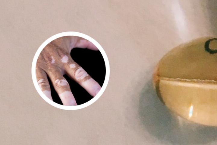东莞到哪看白癜风好