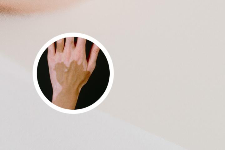 白癜风用铜碗管用吗