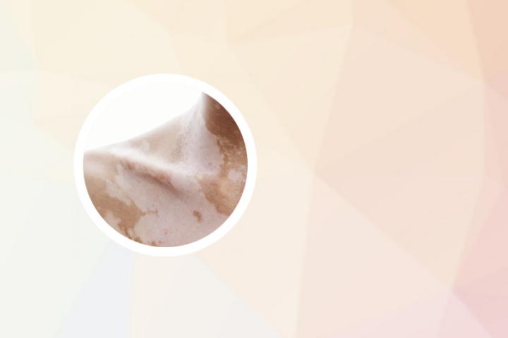 点阵激光可以治疗白癜风