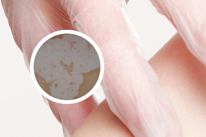 阴部白癜风传染吗