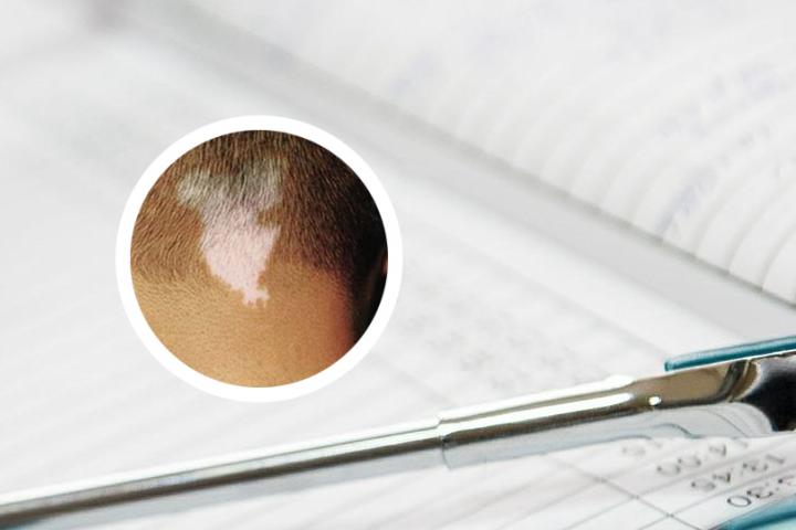 白癜风微创手术