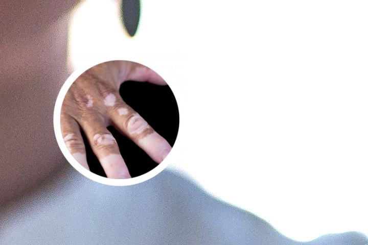 晚期白癜风能彻底治愈吗