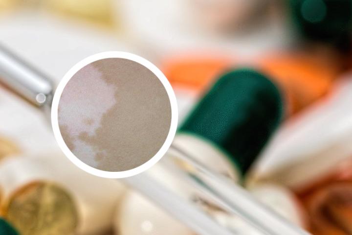 治疗白癜风最难的部位