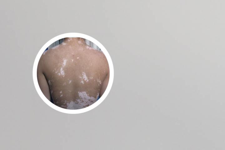 白癜风早期发病图片