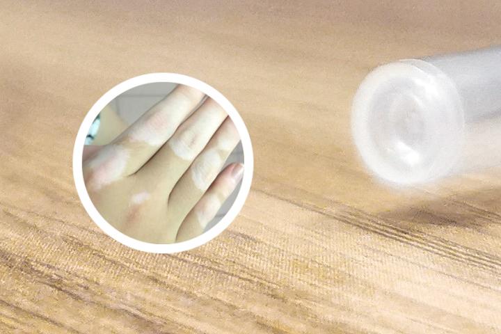 白癜风扩散怎样治疗