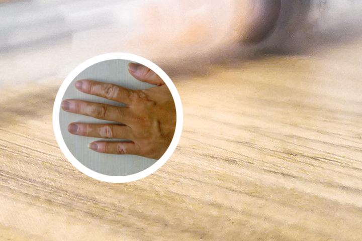 白癜风和痛风哪个好治疗