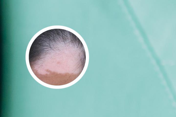 白癜风能吃腌萝卜干吗