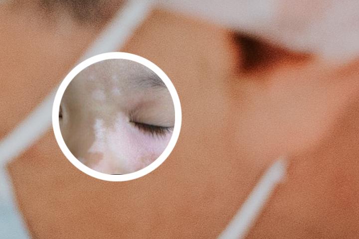 白癜风是怎么患的