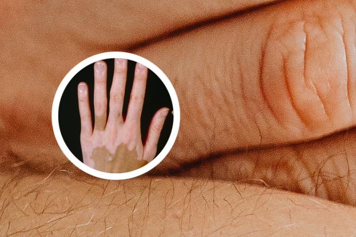 白癜风母婴遗传吗