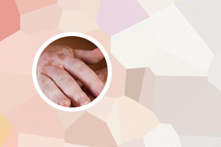 白癜风应注意吃什么