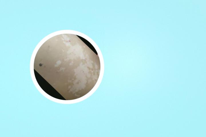 不吃药能不能调理好白癜风