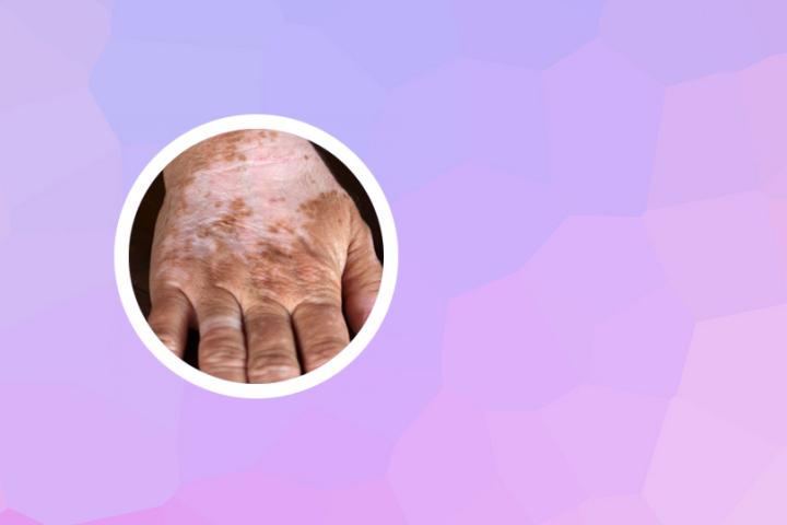 退休后白癜风能治愈吗
