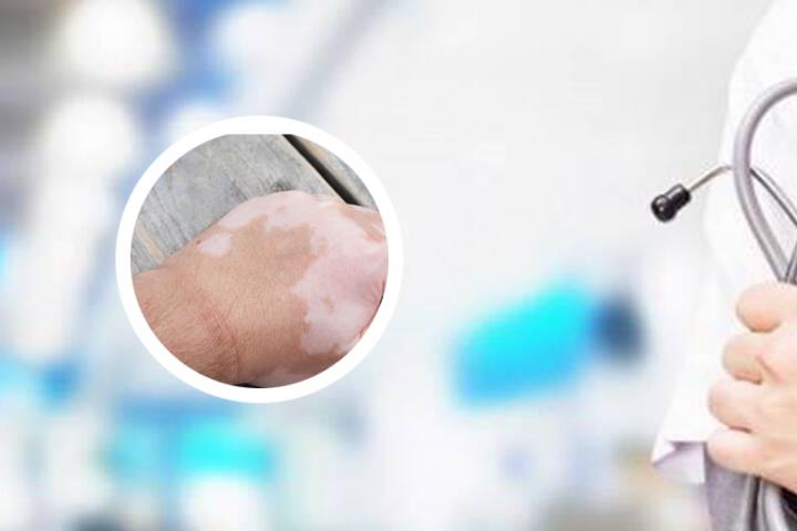 白癜风免疫蛋白a高