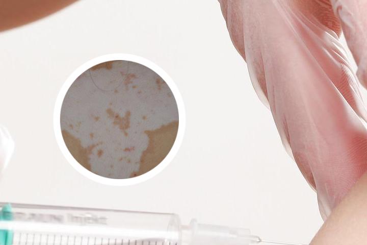 云南白癜风图片长指甲高级