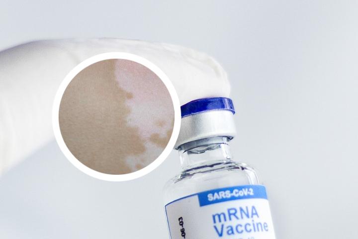 白癜风可以吃阿法骨化醇吗