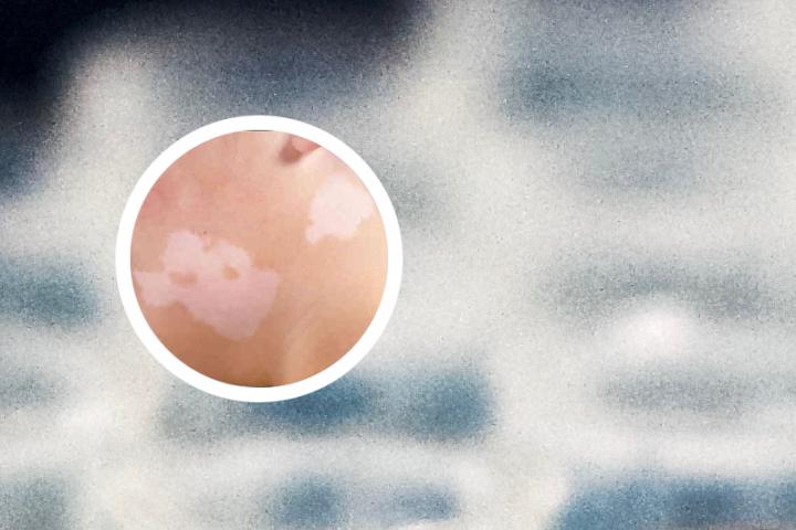 白癜风背上和手臂上怎么办