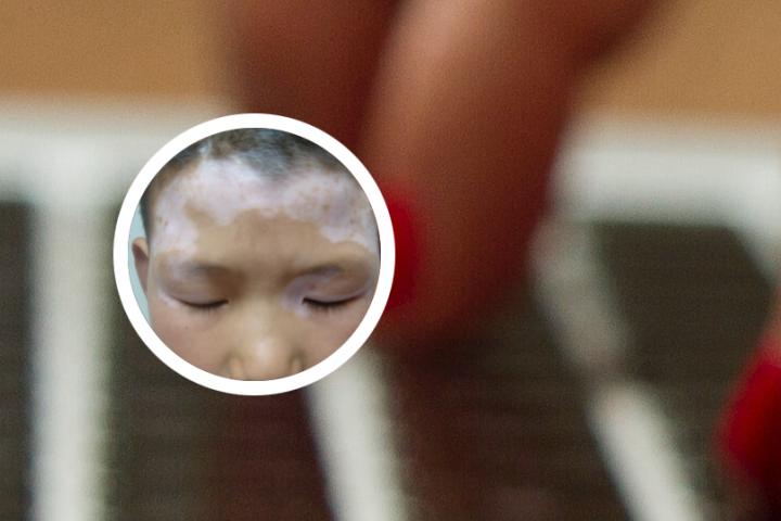 面部白癜风一般治疗多久