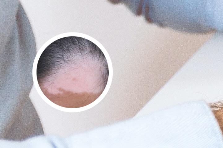 嘴角白癜风怎么治疗好