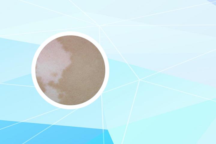 淡白色白癜风需要治疗吗