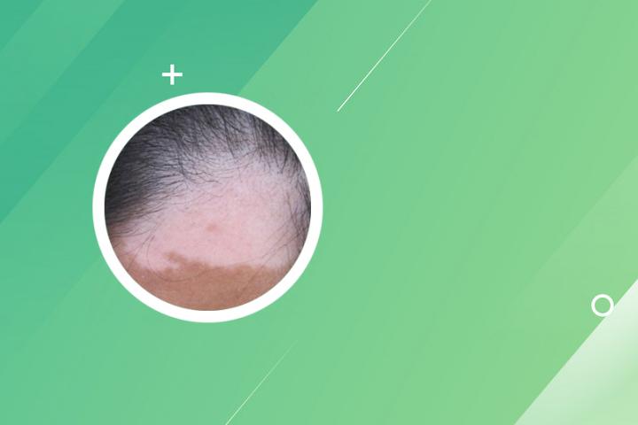 怀疑自己有白癜风怎么检查