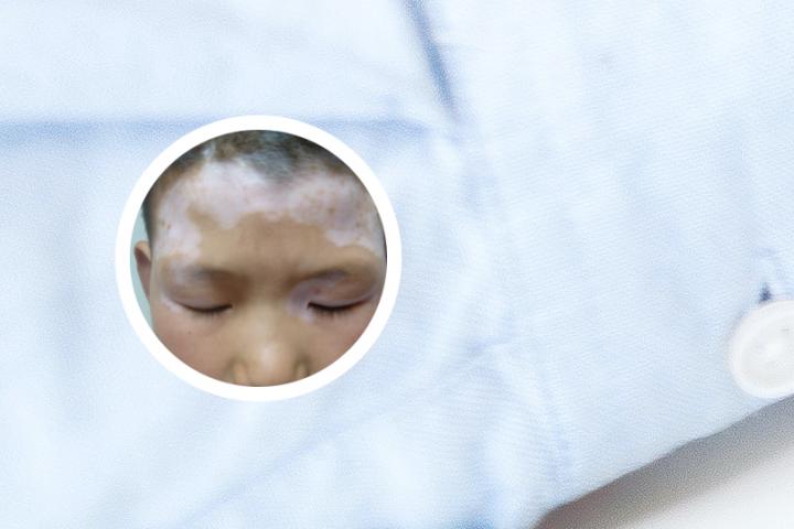 白癜风高危患者