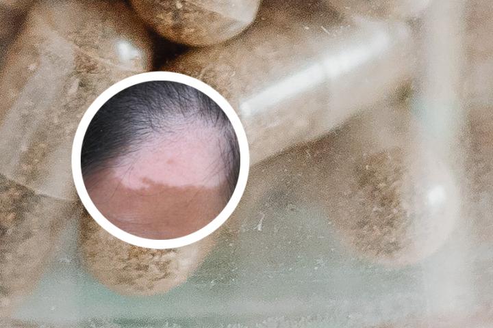 白癜风吃啥维生素好