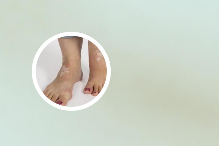 白癜风结婚好吗