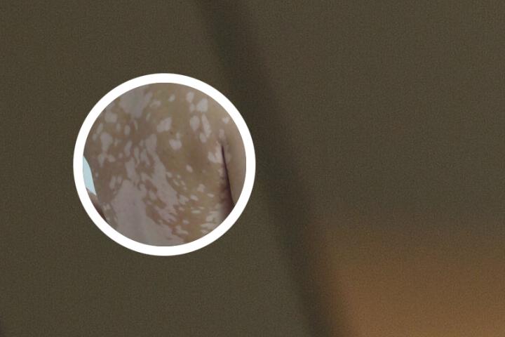 白癜风危害以及原因
