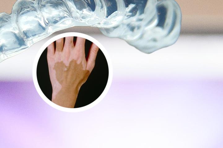 吃白癜风胶囊注意事项