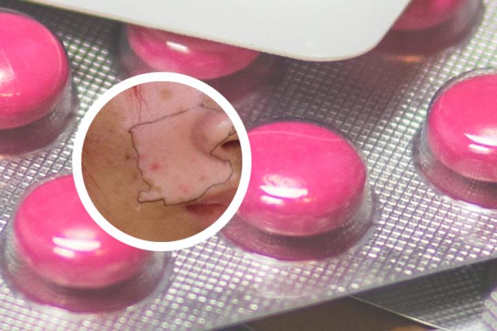 白癜风怎样调理内分泌