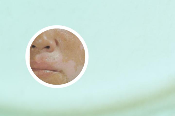 儿童白癜风可以打预防针