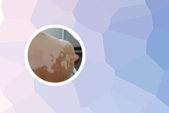 白癜风生活中能吃苹果吗