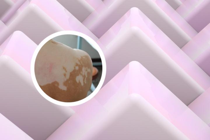 西洋参可以治疗白癜风吗