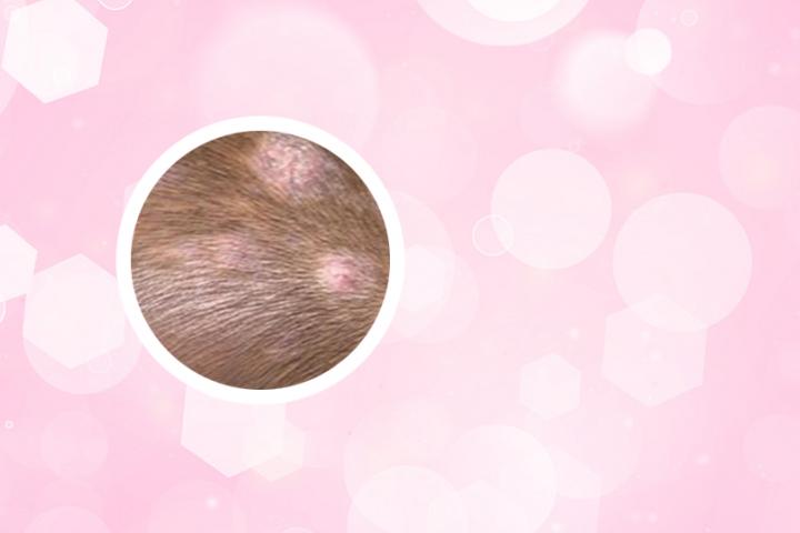 黑芝麻黑玉米能治白癜风吗