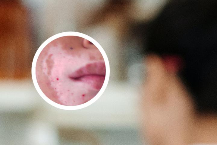 白癜风不可能治愈的