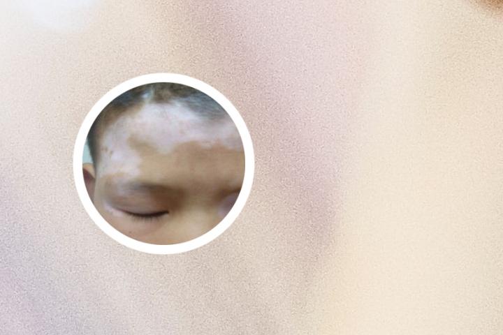 北京看白癜风京城导诊
