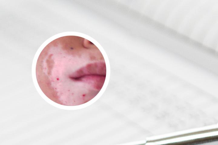 得了白癜风后的生活